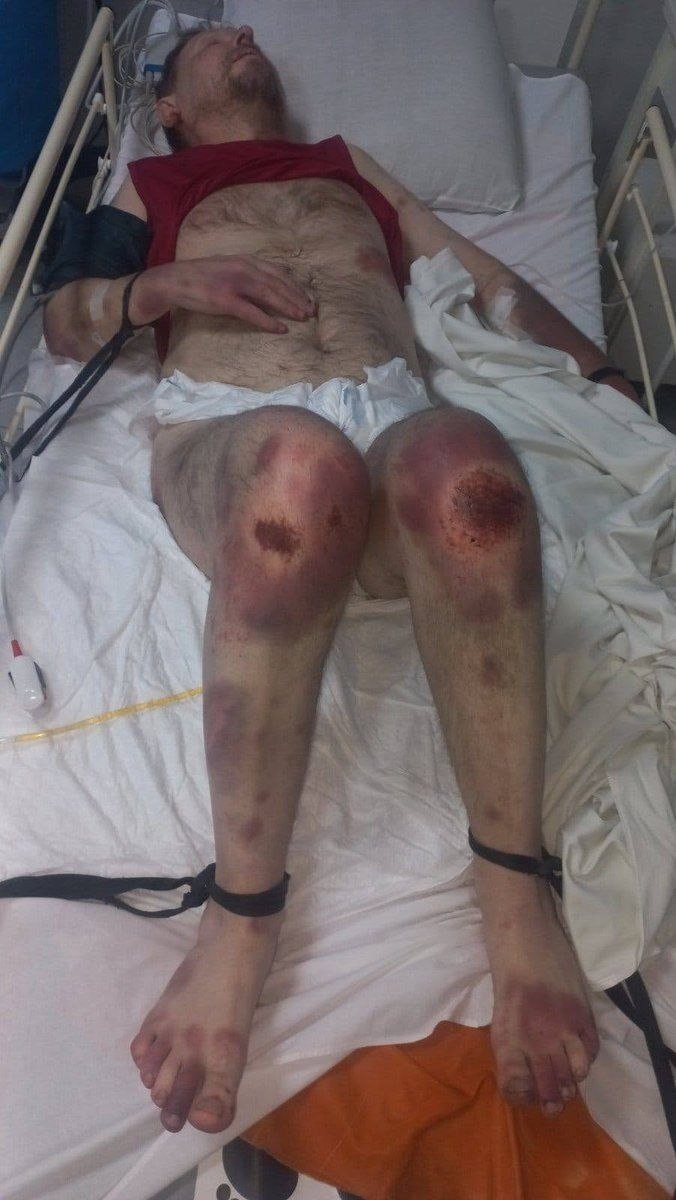 Consequences after Occupant Attack and Four Days of Abuse at TCC in Bila Tserkva